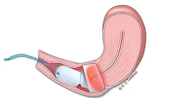 宫颈光是什么意思肿瘤_https://www.jmylbn.com_新闻资讯_第2张