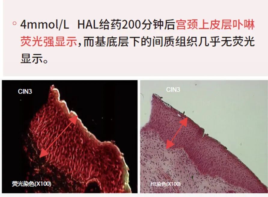 宫颈光是什么意思肿瘤_https://www.jmylbn.com_新闻资讯_第1张
